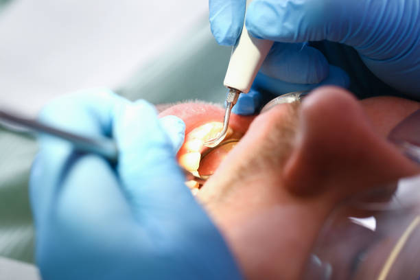 Teeth Whitening in NC
